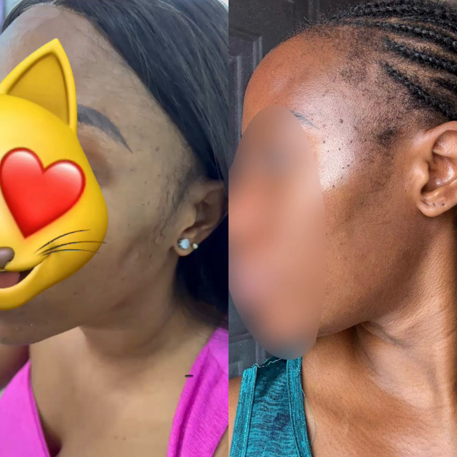 AribelleSkn customer before and after result