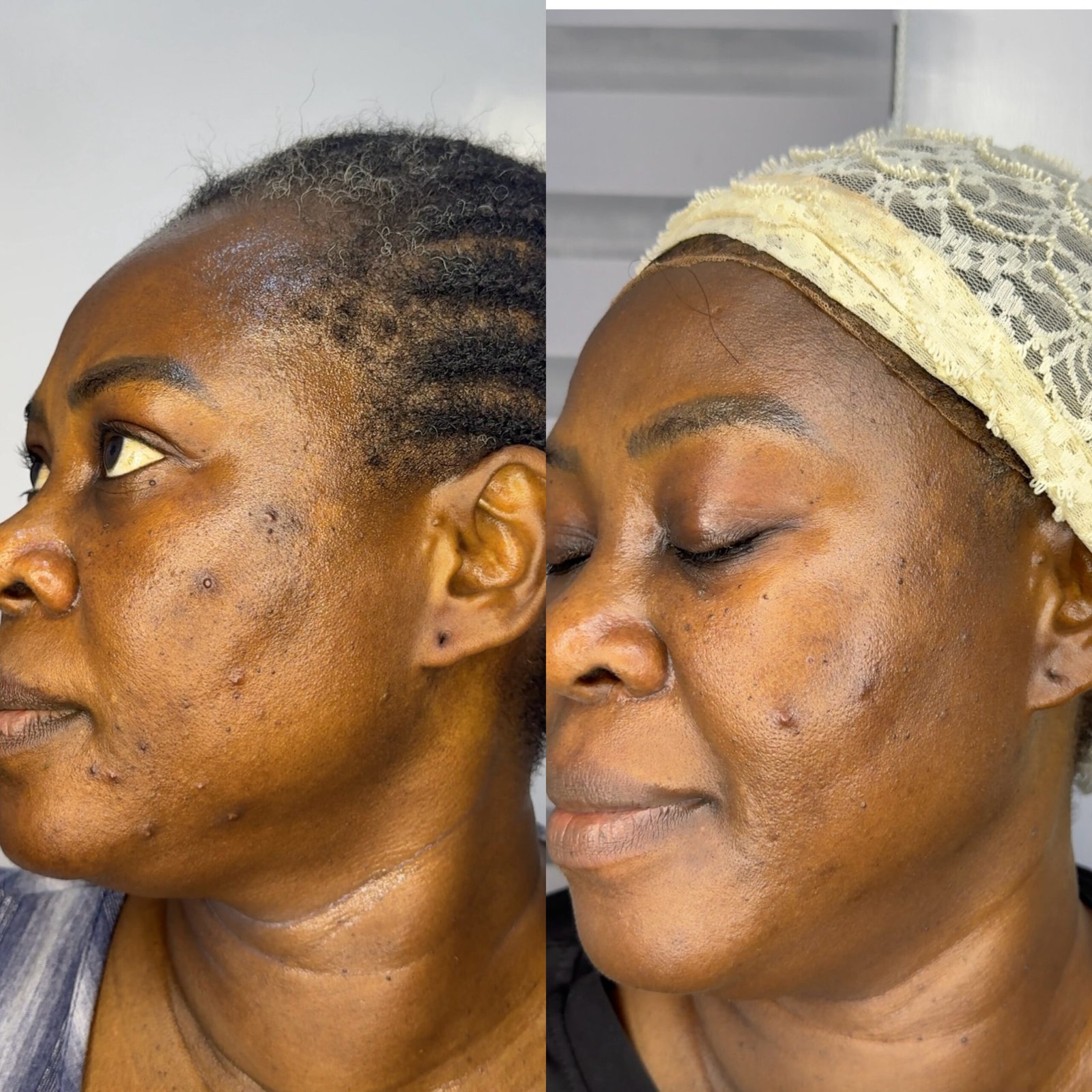 AribelleSkn customized treatment before and after result